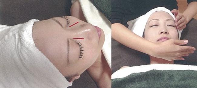 美容鍼灸