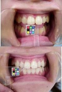 ホームホワイトニング