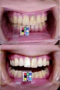 オフィスホワイトニング